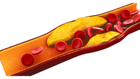 Grafik von Ablagerungen im Blut