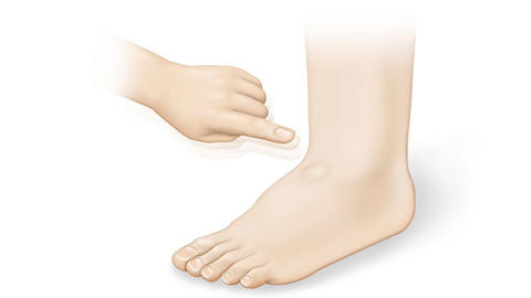 Wassereinlagerungen-Fuss