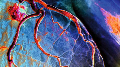 Linke Koronararterie, dargestellt in einer Koronarangiographie