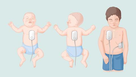 Grafik: Anwendung eines automatisierten externen Defibrillators (AED)